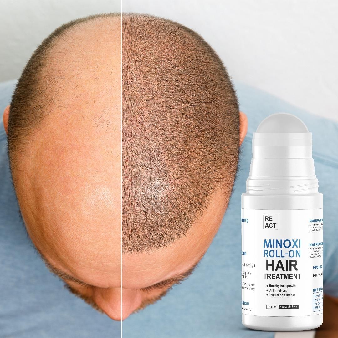 Minoxi Roll - On Hair Treatment Hair Growth Serum For Women & Men - Wishlect