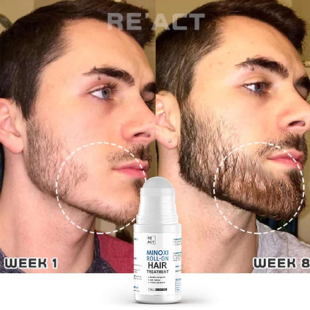 Minoxi Roll - On Hair Treatment Hair Growth Serum For Women & Men - Wishlect