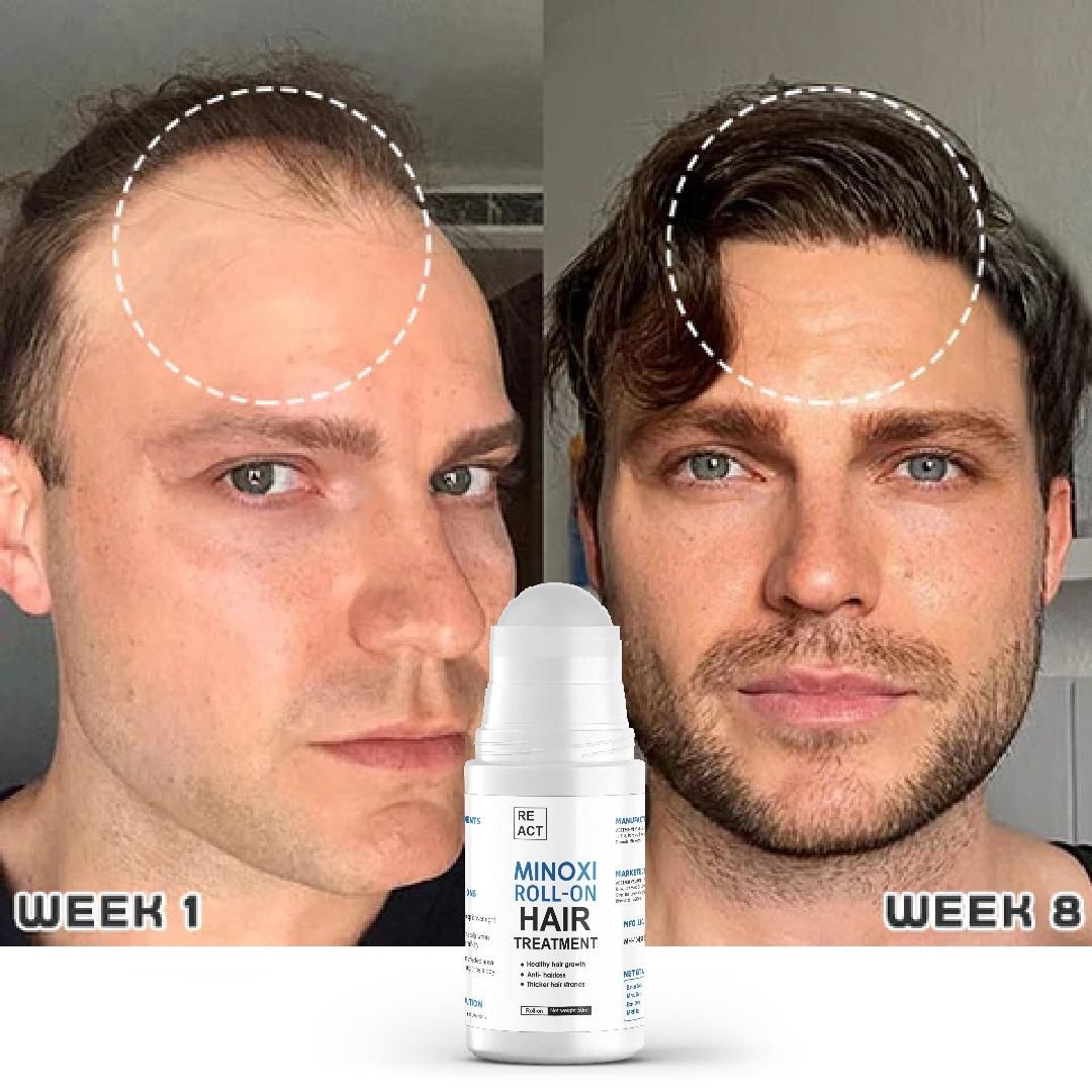 Minoxi Roll - On Hair Treatment Hair Growth Serum For Women & Men - Wishlect